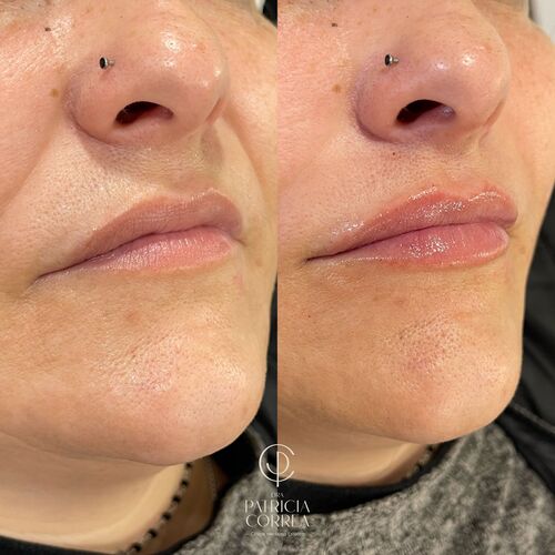 Aumento de Labios Manresa