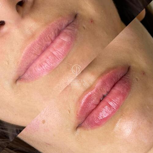 Aumento de Labios