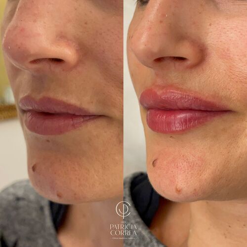 Centro Aumento de Labios en Manresa