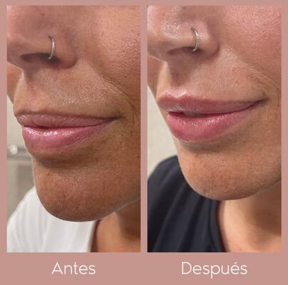 Fotos del relleno de labios con ácido hialurónico antes y después