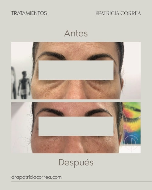 Relleno de Ojeras en Manresa